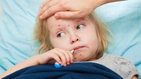 Measles outbreak in the United States
